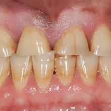 tooth wear bruxism